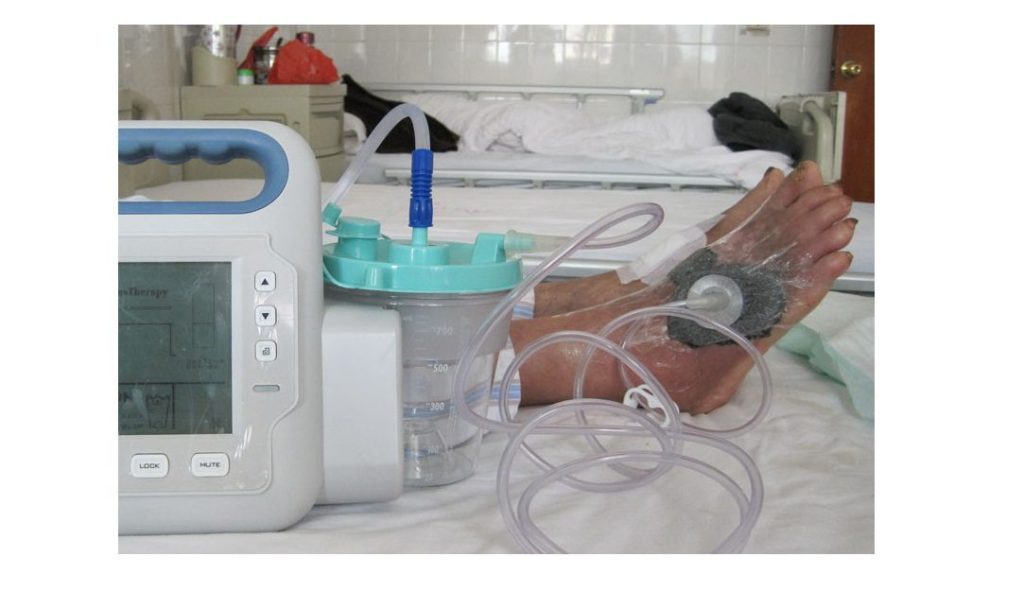 Foryou Npwt /negative Pressure Wound Treatment - Image 4