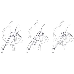 CCL Lateral Nylon Sutures Double - no Crimp