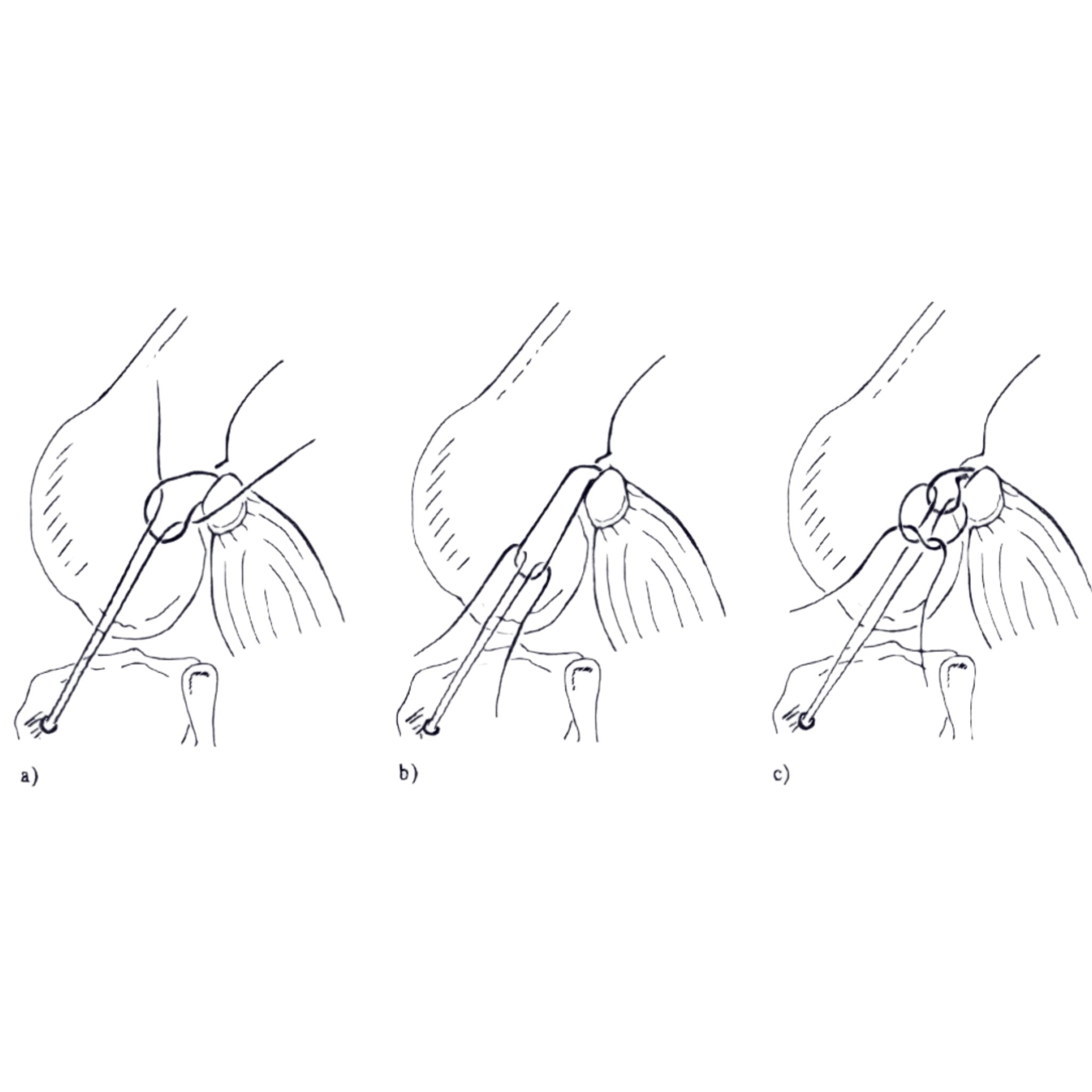 CCL Lateral Nylon Sutures Double - no Crimp