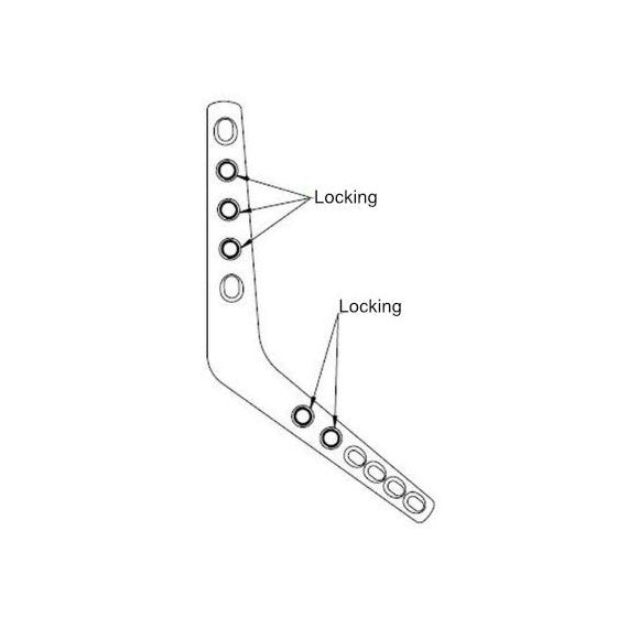 Elbow Arthrodesis Plate 3.5mm/2.7mm - Image 4