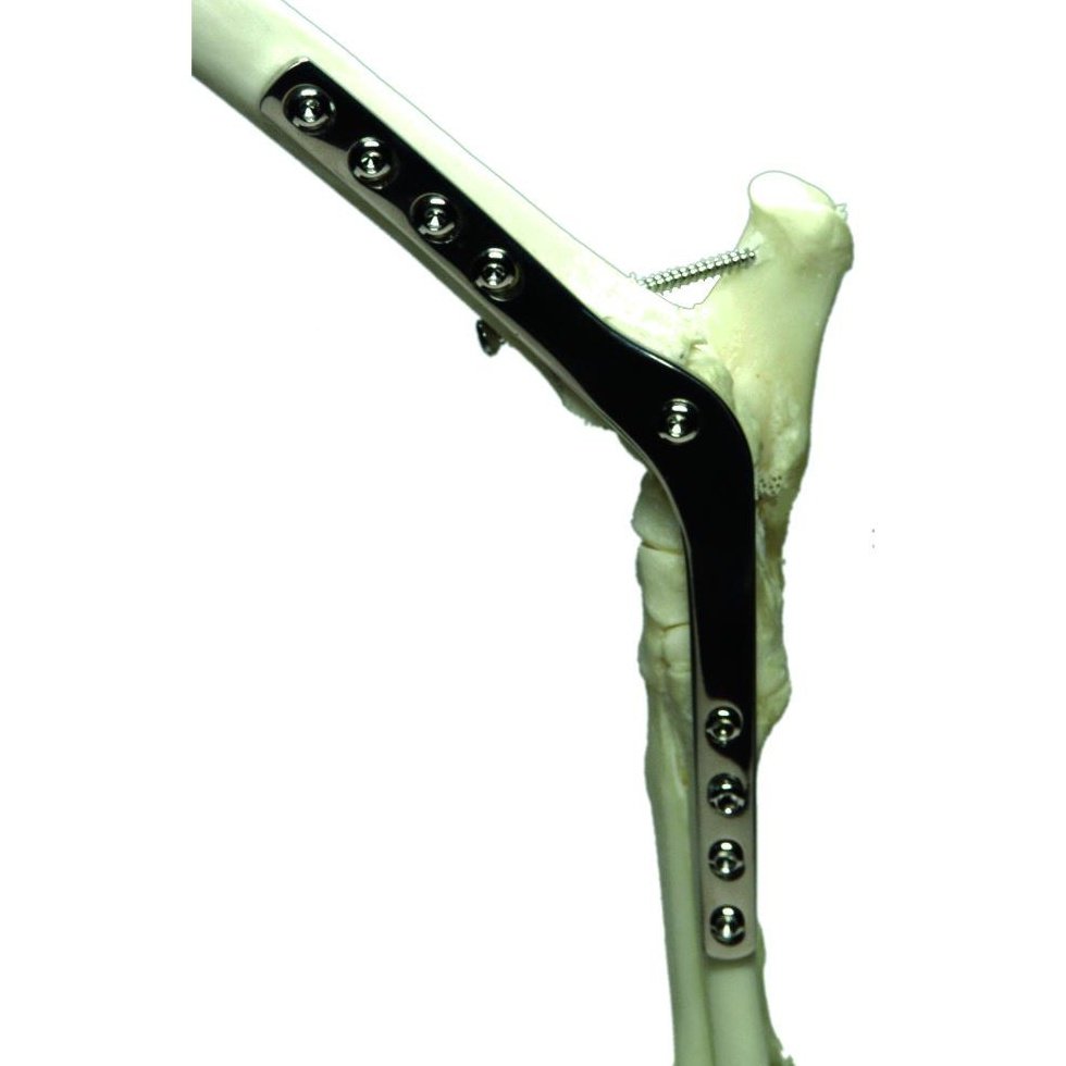 Pantarsal Arthrodesis Plate - Image 2