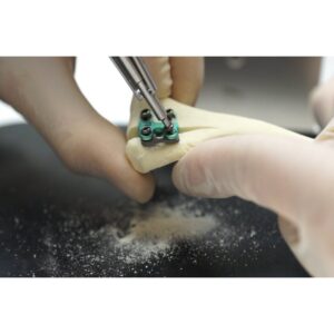 Patella Rapid Luxation Spacers