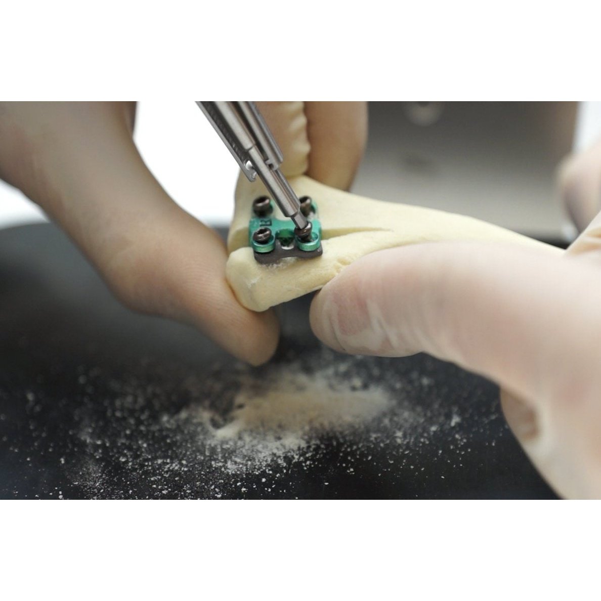 Patella Rapid Luxation Spacers